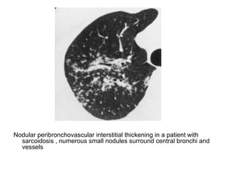 Nodular peribronchovascular interstitial thickening in a patient with
sarcoidosis , numerous small nodules surround central bronchi and
vessels
 