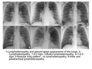 1-Lymphadenopathy and ground glass appearance of the lungs, 2-
Lymphadenopathy, 1-2-3 sign, 3-Bulky lymphadenopathy, 4-1-2-3
sign, 5-Nodular lung pattern , no lymphadenopathy, 6-Hilar and
paratracheal lymphadenopathy
 