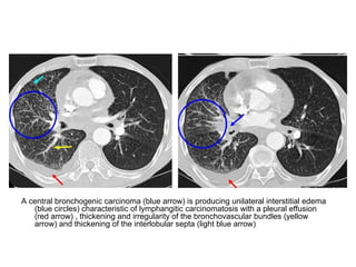 A central bronchogenic carcinoma (blue arrow) is producing unilateral interstitial edema
(blue circles) characteristic of lymphangitic carcinomatosis with a pleural effusion
(red arrow) , thickening and irregularity of the bronchovascular bundles (yellow
arrow) and thickening of the interlobular septa (light blue arrow)
 