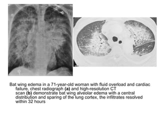 Bat wing edema in a 71-year-old woman with fluid overload and cardiac
failure, chest radiograph (a) and high-resolution CT
scan (b) demonstrate bat wing alveolar edema with a central
distribution and sparing of the lung cortex, the infiltrates resolved
within 32 hours
 