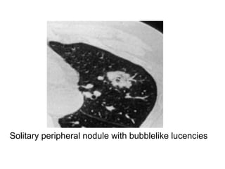 Solitary peripheral nodule with bubblelike lucencies
 