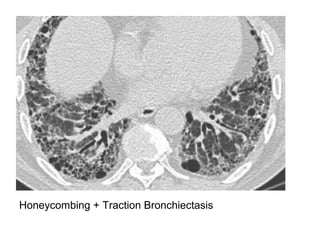 Honeycombing + Traction Bronchiectasis
 