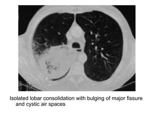 Isolated lobar consolidation with bulging of major fissure
and cystic air spaces
 