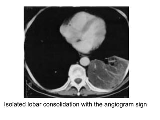Isolated lobar consolidation with the angiogram sign
 