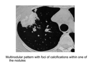Multinodular pattern with foci of calcifications within one of
the nodules
 