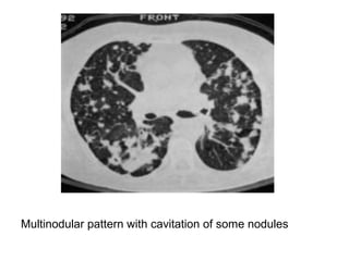 Multinodular pattern with cavitation of some nodules
 
