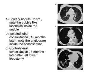 a) Solitary nodule , 2 cm ,
note the bubble like
lucencies inside the
nodule
b) Isolated lobar
consolidation , 15 months
later , note the angiogram
inside the consolidation
c) Contralateral
consolidation , 4 months
later after left lower
lobectomy
 