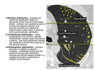 1-Random distribution , nodules are
randomly distributed relative to
structures of the lung and secondary
lobule , nodules can usually be seen to
involve the pleural surfaces and
fissures but lack the subpleural
predominance often seen in patients
with a perilymphatic distribution
2-Centrilobular distribution , unlike
perilymphatic and random nodules ,
centrilobular nodules spare the pleural
surfaces , the most peripheral nodules
are centered 5-10mm from fissures or
the pleural surface
3-Perilymphatic distribution , nodules
are seen in relation to pleural
surfaces , interlobular septa and the
peribronchovascular interstitium ,
nodules are almost always visible in a
subpleural location particularly in
relation to the fissures
 
