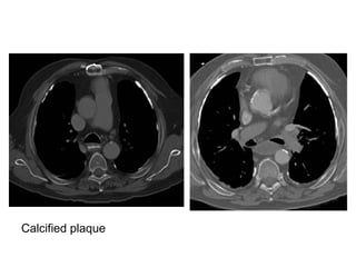 Calcified plaque
 