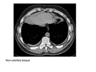 Non-calcified plaque
 