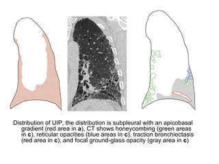 Distribution of UIP, the distribution is subpleural with an apicobasal
gradient (red area in a), CT shows honeycombing (green areas
in c), reticular opacities (blue areas in c), traction bronchiectasis
(red area in c), and focal ground-glass opacity (gray area in c)
 