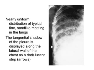Nearly uniform
distribution of typical
fine, sandlike mottling
in the lungs
The tangential shadow
of the pleura is
displayed along the
lateral wall of the
chest as a dark lucent
strip (arrows)
 