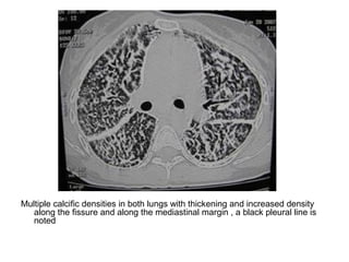 Multiple calcific densities in both lungs with thickening and increased density
along the fissure and along the mediastinal margin , a black pleural line is
noted
 