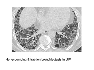 Honeycombing & traction bronchiectasis in UIP
 