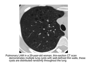 Pulmonary LAM in a 29-year-old woman, thin-section CT scan
demonstrates multiple lung cysts with well-defined thin walls, these
cysts are distributed randomly throughout the lung
 