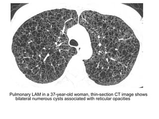 Pulmonary LAM in a 37-year-old woman, thin-section CT image shows
bilateral numerous cysts associated with reticular opacities
 