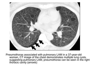 Pneumothorax associated with pulmonary LAM in a 37-year-old
woman, CT image of the chest demonstrates multiple lung cysts,
suggesting pulmonary LAM, pneumothorax can be seen in the right
thoracic cavity (arrows)
 