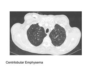 Centrilobular Emphysema
 