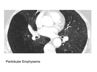 Panlobular Emphysema
 