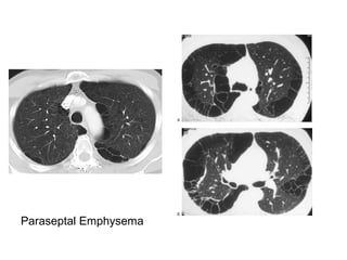 Paraseptal Emphysema
 