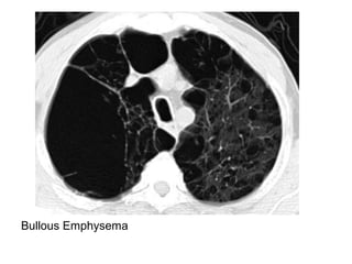 Bullous Emphysema
 