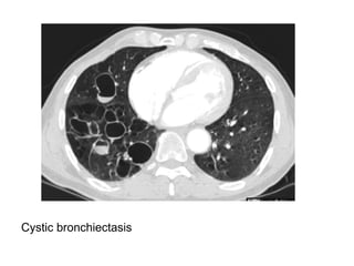 Cystic bronchiectasis
 