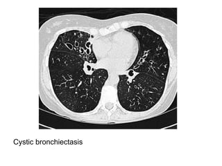 Cystic bronchiectasis
 