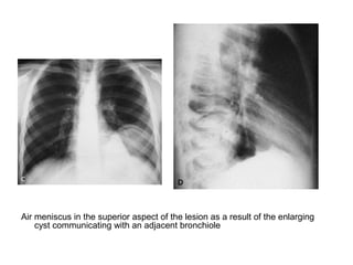 Air meniscus in the superior aspect of the lesion as a result of the enlarging
cyst communicating with an adjacent bronchiole
 
