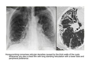 Honeycombing comprises reticular densities caused by the thick walls of the cysts.
Whenever you see a chest film with long standing reticulation with a lower lobe and
peripheral preference
 