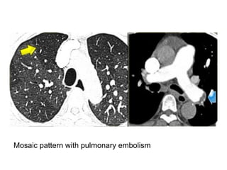 Mosaic pattern with pulmonary embolism
 