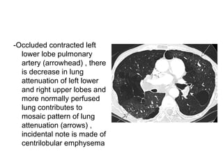 -Occluded contracted left
lower lobe pulmonary
artery (arrowhead) , there
is decrease in lung
attenuation of left lower
and right upper lobes and
more normally perfused
lung contributes to
mosaic pattern of lung
attenuation (arrows) ,
incidental note is made of
centrilobular emphysema
 