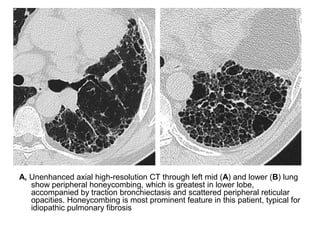 A, Unenhanced axial high-resolution CT through left mid (A) and lower (B) lung
show peripheral honeycombing, which is greatest in lower lobe,
accompanied by traction bronchiectasis and scattered peripheral reticular
opacities. Honeycombing is most prominent feature in this patient, typical for
idiopathic pulmonary fibrosis
 