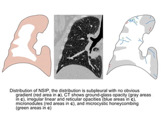 Distribution of NSIP, the distribution is subpleural with no obvious
gradient (red area in a), CT shows ground-glass opacity (gray areas
in c), irregular linear and reticular opacities (blue areas in c),
micronodules (red areas in c), and microcystic honeycombing
(green areas in c)
 