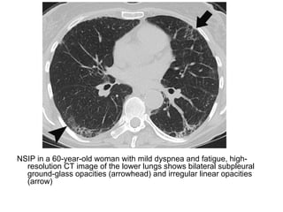 NSIP in a 60-year-old woman with mild dyspnea and fatigue, high-
resolution CT image of the lower lungs shows bilateral subpleural
ground-glass opacities (arrowhead) and irregular linear opacities
(arrow)
 
