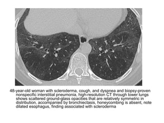 48-year-old woman with scleroderma, cough, and dyspnea and biopsy-proven
nonspecific interstitial pneumonia, high-resolution CT through lower lungs
shows scattered ground-glass opacities that are relatively symmetric in
distribution, accompanied by bronchiectasis, honeycombing is absent, note
dilated esophagus, finding associated with scleroderma
 