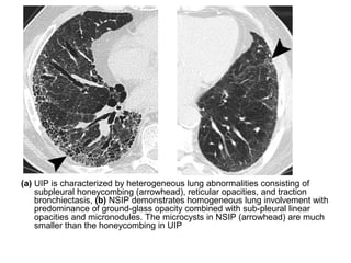 (a) UIP is characterized by heterogeneous lung abnormalities consisting of
subpleural honeycombing (arrowhead), reticular opacities, and traction
bronchiectasis, (b) NSIP demonstrates homogeneous lung involvement with
predominance of ground-glass opacity combined with sub-pleural linear
opacities and micronodules. The microcysts in NSIP (arrowhead) are much
smaller than the honeycombing in UIP
 