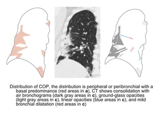 Distribution of COP, the distribution is peripheral or peribronchial with a
basal predominance (red areas in a), CT shows consolidation with
air bronchograms (dark gray areas in c), ground-glass opacities
(light gray areas in c), linear opacities (blue areas in c), and mild
bronchial dilatation (red areas in c)
 