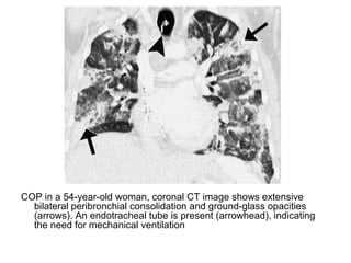 COP in a 54-year-old woman, coronal CT image shows extensive
bilateral peribronchial consolidation and ground-glass opacities
(arrows). An endotracheal tube is present (arrowhead), indicating
the need for mechanical ventilation
 
