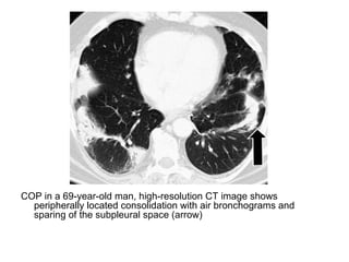 COP in a 69-year-old man, high-resolution CT image shows
peripherally located consolidation with air bronchograms and
sparing of the subpleural space (arrow)
 