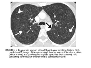 RB-ILD in a 44-year-old woman with a 20 pack-year smoking history, high-
resolution CT image of the upper lung lobes shows centrilobular nodules
(white arrows) and patchy ground-glass opacities (black arrow), mild
coexisting centrilobular emphysema is seen (arrowhead)
 