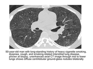 50-year-old man with long-standing history of heavy cigarette smoking,
dyspnea, cough, and smoking-related interstitial lung disease,
proven at biopsy, unenhanced axial CT image through mid to lower
lungs shows diffuse centrilobular ground-glass nodules bilaterally
 