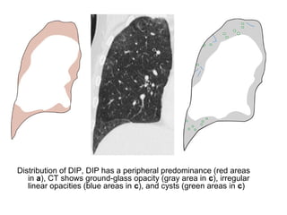 Distribution of DIP, DIP has a peripheral predominance (red areas
in a), CT shows ground-glass opacity (gray area in c), irregular
linear opacities (blue areas in c), and cysts (green areas in c)
 