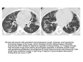 49-year-old woman with persistent and progressive cough, dyspnea, and hypoxemia,
prompting biopsy of her lungs, which revealed chronic desquamative interstitial
pneumonia (DIP) related to extensive cigarette smoking history, CT images through
mid and lower lungs show patchy ground-glass opacities in all lobes of both lungs
with peripheral predilection accompanied by lower lobe bronchial wall thickening, note
small cysts scattered mostly in right lung in regions of ground-glass attenuation,
finding that can occur in DIP
 
