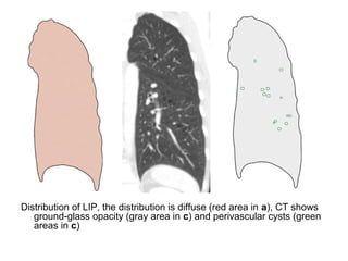 Distribution of LIP, the distribution is diffuse (red area in a), CT shows
ground-glass opacity (gray area in c) and perivascular cysts (green
areas in c)
 