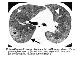 LIP in a 47-year-old woman, high-resolution CT image shows diffuse
ground-glass opacity (arrow) with multiple perivascular cysts
(arrowheads) and reticular abnormalities (*)
 