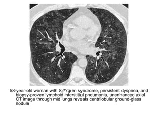 58-year-old woman with Sj??gren syndrome, persistent dyspnea, and
biopsy-proven lymphoid interstitial pneumonia, unenhanced axial
CT image through mid lungs reveals centrilobular ground-glass
nodule
 