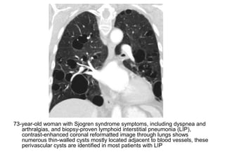 73-year-old woman with Sjogren syndrome symptoms, including dyspnea and
arthralgias, and biopsy-proven lymphoid interstitial pneumonia (LIP),
contrast-enhanced coronal reformatted image through lungs shows
numerous thin-walled cysts mostly located adjacent to blood vessels, these
perivascular cysts are identified in most patients with LIP
 