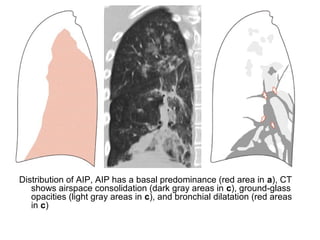 Distribution of AIP, AIP has a basal predominance (red area in a), CT
shows airspace consolidation (dark gray areas in c), ground-glass
opacities (light gray areas in c), and bronchial dilatation (red areas
in c)
 