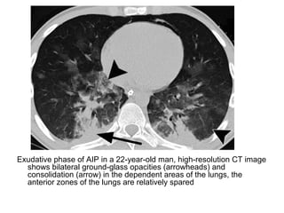 Exudative phase of AIP in a 22-year-old man, high-resolution CT image
shows bilateral ground-glass opacities (arrowheads) and
consolidation (arrow) in the dependent areas of the lungs, the
anterior zones of the lungs are relatively spared
 
