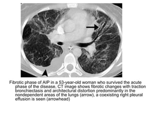 Fibrotic phase of AIP in a 53-year-old woman who survived the acute
phase of the disease, CT image shows fibrotic changes with traction
bronchiectasis and architectural distortion predominantly in the
nondependent areas of the lungs (arrow), a coexisting right pleural
effusion is seen (arrowhead)
 